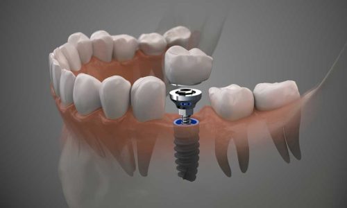 DentalImplant-AdobeStock_262324327